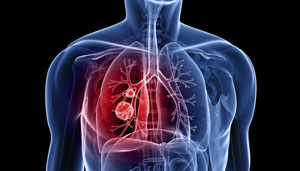 Lung cancer treatments discussed at meeting
