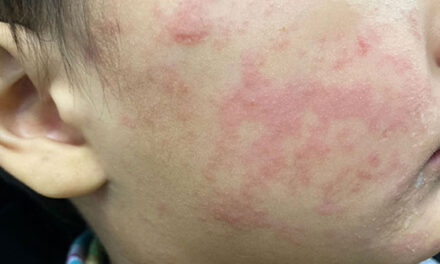 State urges vaccinations amidst rise in measles