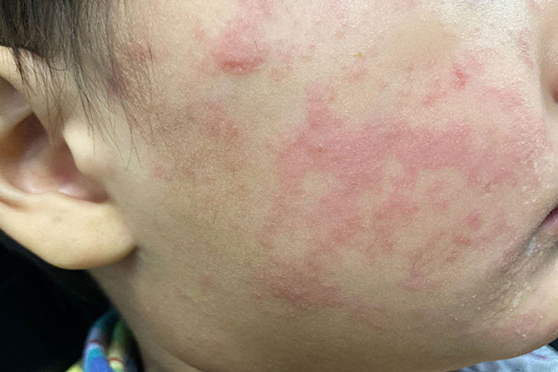 State urges vaccinations amidst rise in measles